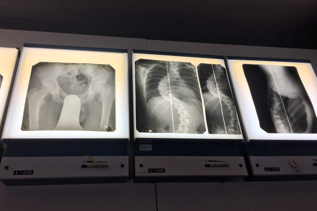 Staré rentgenové snímky z Hamzovy léčebny | foto: Josef Kopecký,  Český rozhlas