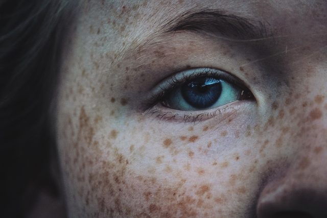 Vyšetření znamének na kůži je jednoduché nebolí | foto: Fotobanka Pixabay