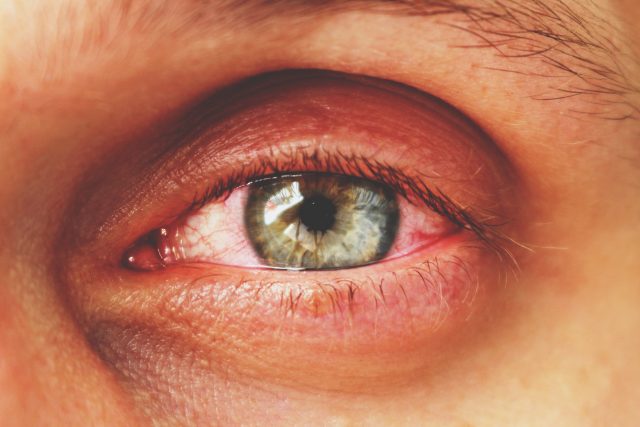 Trápí vás zarudlé oči? | foto: Profimedia