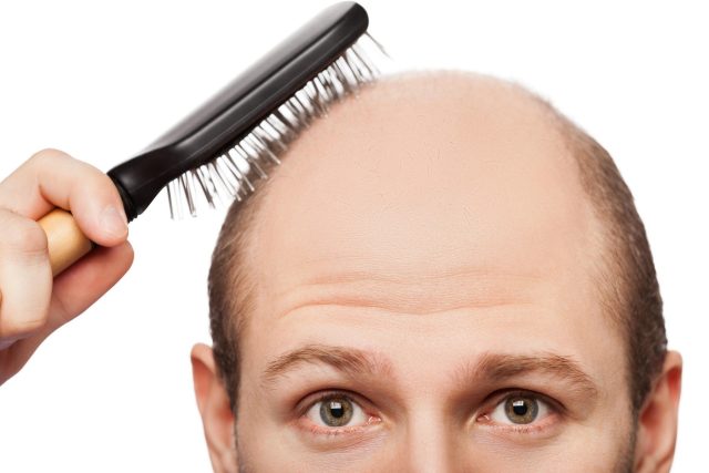 Alopecie,  tedy plešatění,  se týká především mužů | foto: Profimedia