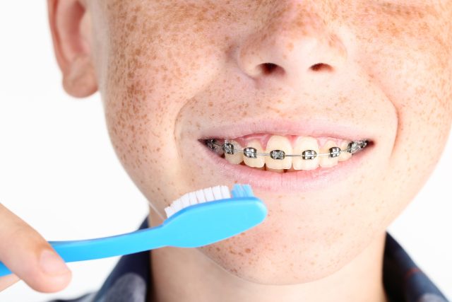 Správná a častá zubní hygiena je při používání rovnátek klíčová | foto: Profimedia